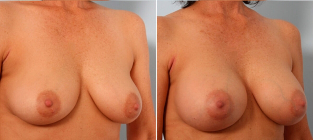 Breast Augmentation before and after photos in Houston, TX, Patient 24831