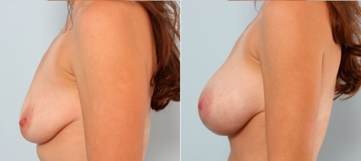 Breast Augmentation before and after photos in Houston, TX, Patient 24842