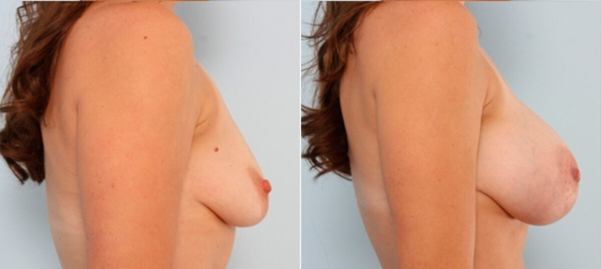 Breast Augmentation before and after photos in Houston, TX, Patient 24842