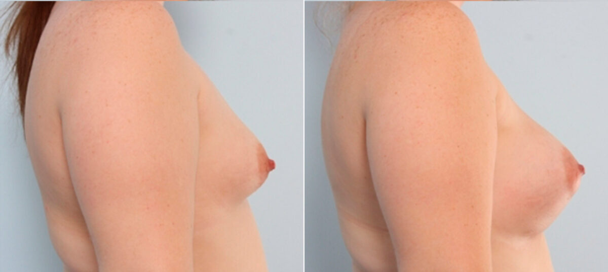 Breast Augmentation before and after photos in Houston, TX, Patient 24853