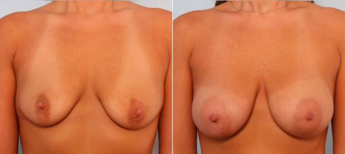 Breast Augmentation before and after photos in Houston, TX, Patient 24864