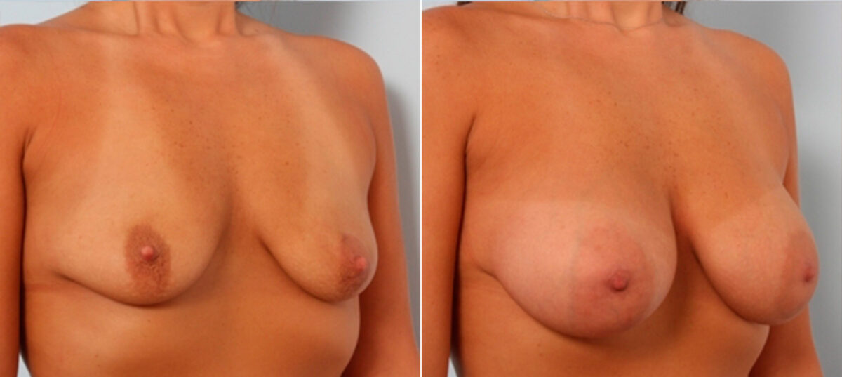 Breast Augmentation before and after photos in Houston, TX, Patient 24864