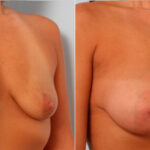 Breast Augmentation before and after photos in Houston, TX, Patient 24864