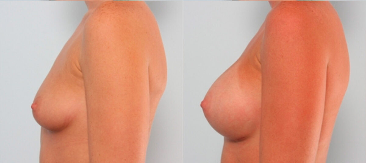 Breast Augmentation before and after photos in Houston, TX, Patient 24875