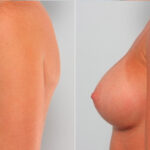 Breast Augmentation before and after photos in Houston, TX, Patient 24875