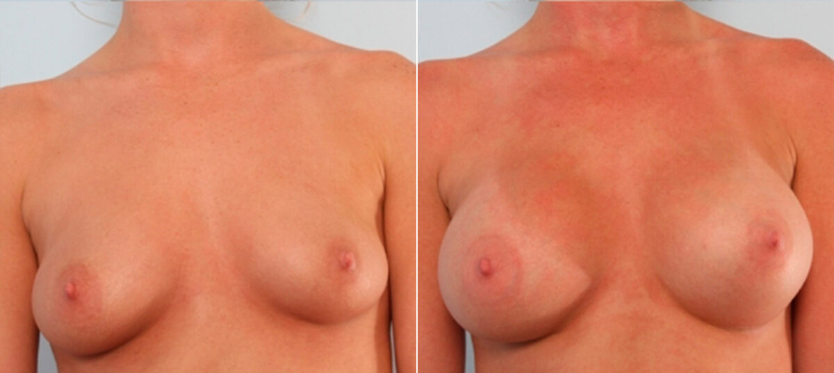 Breast Augmentation before and after photos in Houston, TX, Patient 24875