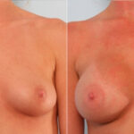 Breast Augmentation before and after photos in Houston, TX, Patient 24875