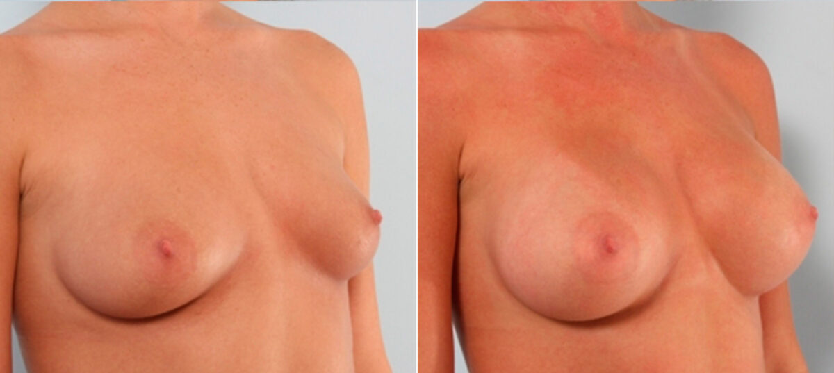 Breast Augmentation before and after photos in Houston, TX, Patient 24875