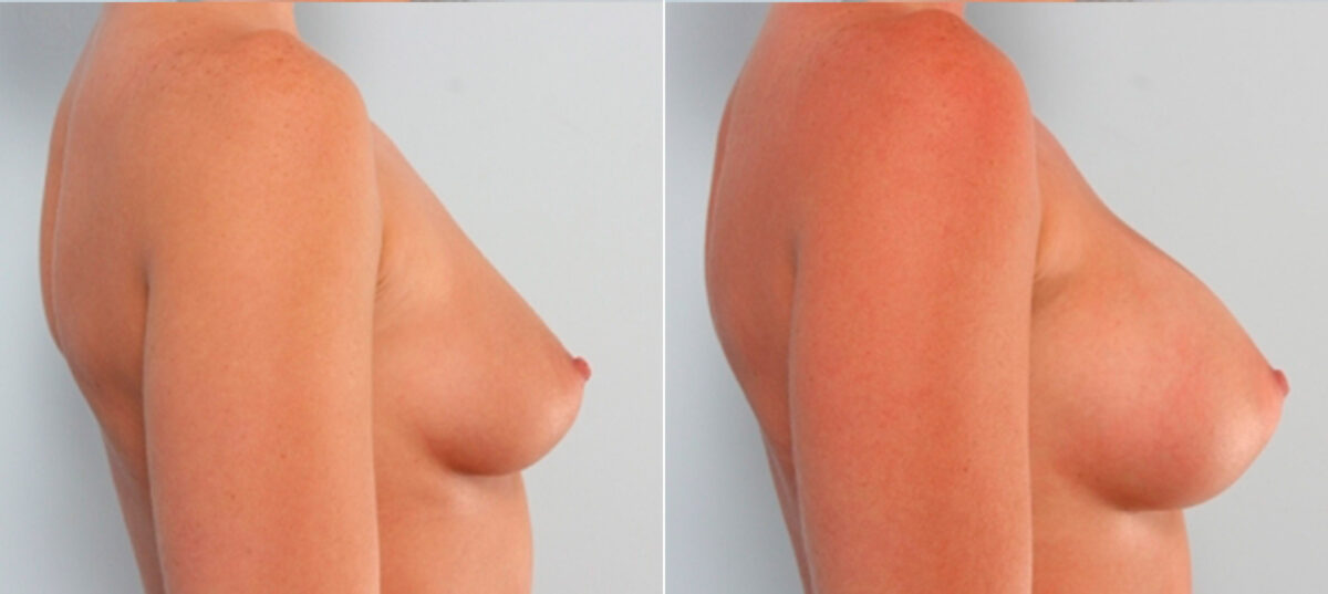 Breast Augmentation before and after photos in Houston, TX, Patient 24875