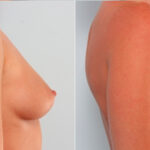 Breast Augmentation before and after photos in Houston, TX, Patient 24875
