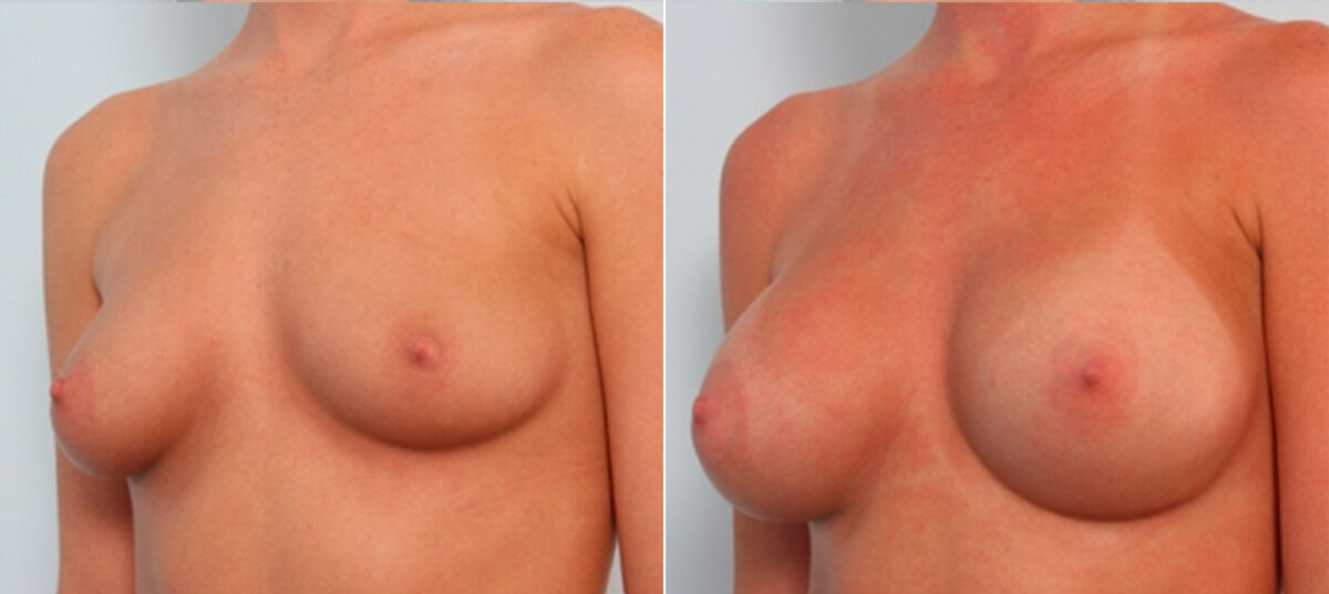 Breast Augmentation before and after photos in Houston, TX, Patient 24875