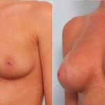 Breast Augmentation before and after photos in Houston, TX, Patient 24875