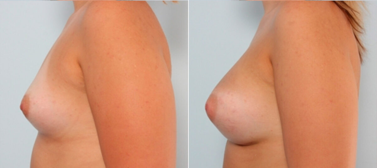 Breast Augmentation before and after photos in Houston, TX, Patient 24886