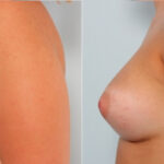 Breast Augmentation before and after photos in Houston, TX, Patient 24886