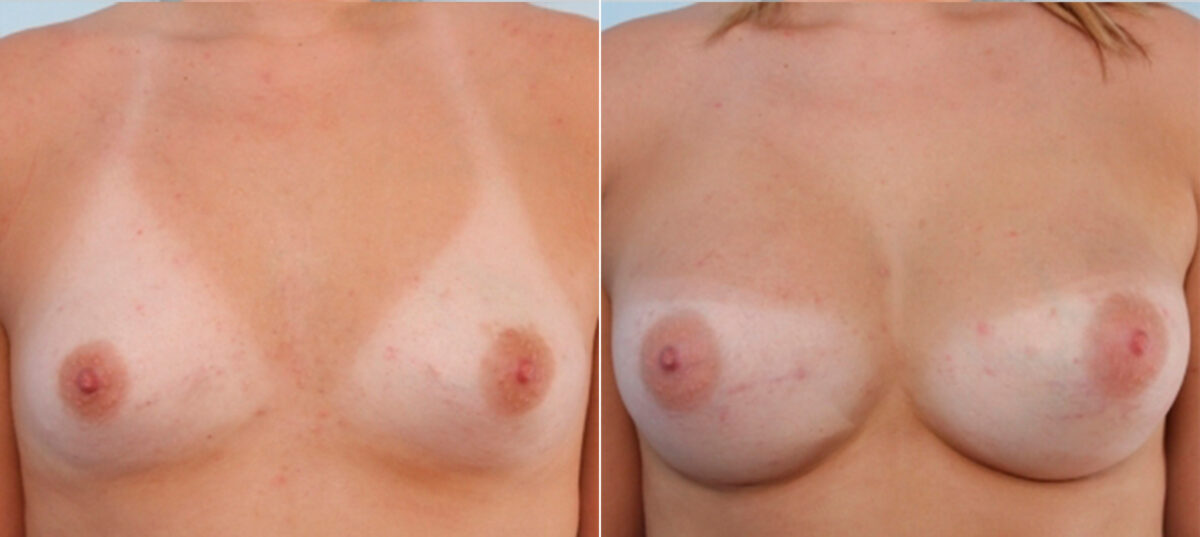 Breast Augmentation before and after photos in Houston, TX, Patient 24886