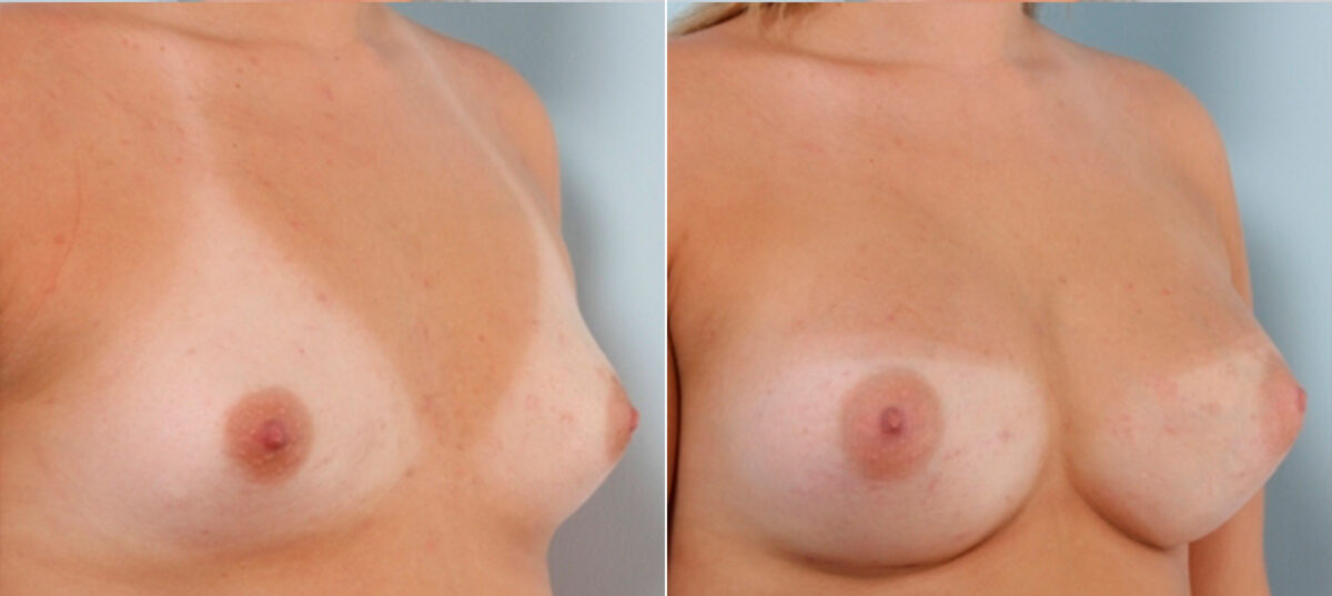 Breast Augmentation before and after photos in Houston, TX, Patient 24886