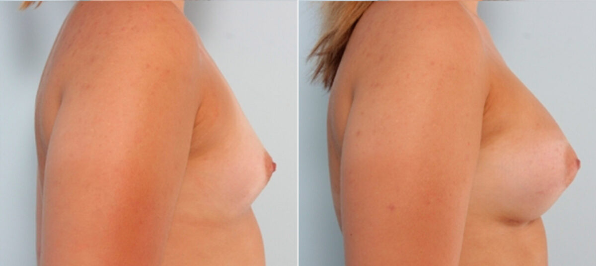 Breast Augmentation before and after photos in Houston, TX, Patient 24886