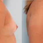 Breast Augmentation before and after photos in Houston, TX, Patient 24886