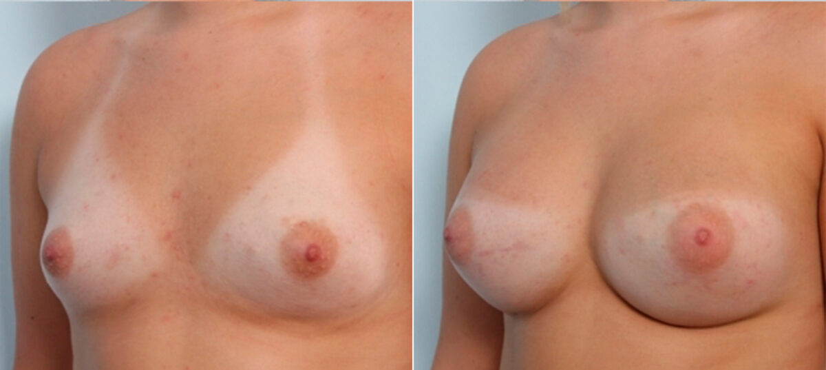 Breast Augmentation before and after photos in Houston, TX, Patient 24886