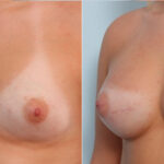 Breast Augmentation before and after photos in Houston, TX, Patient 24886