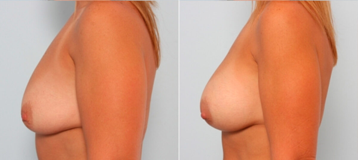 Breast Augmentation before and after photos in Houston, TX, Patient 24897