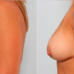 Breast Augmentation before and after photos in Houston, TX, Patient 24897