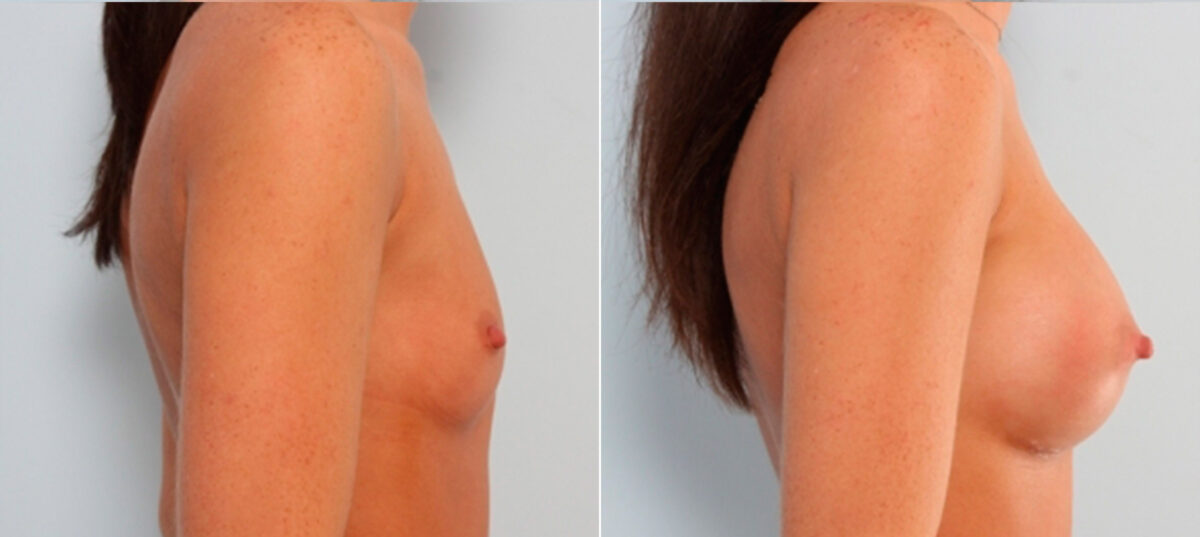 Breast Augmentation before and after photos in Houston, TX, Patient 24908