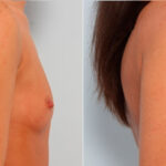 Breast Augmentation before and after photos in Houston, TX, Patient 24908