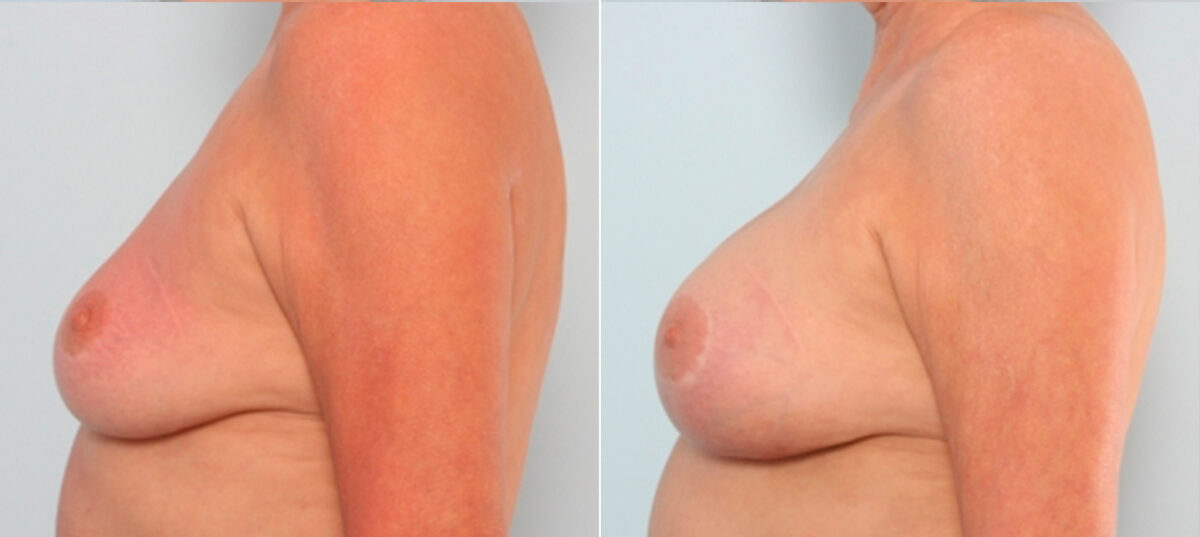 Breast Augmentation before and after photos in Houston, TX, Patient 24919