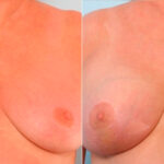 Breast Augmentation before and after photos in Houston, TX, Patient 24919