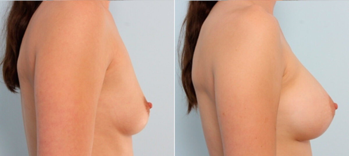 Breast Augmentation before and after photos in Houston, TX, Patient 24930
