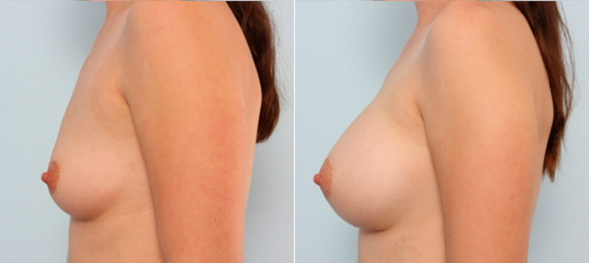 Breast Augmentation before and after photos in Houston, TX, Patient 24930