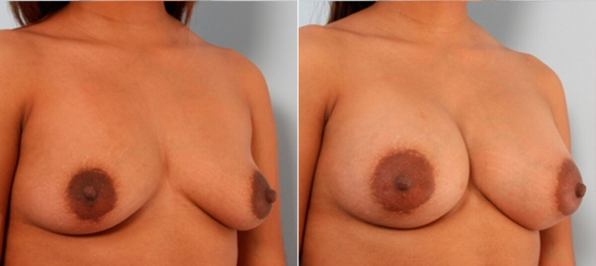 Breast Augmentation before and after photos in Houston, TX, Patient 24941