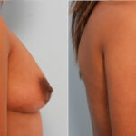 Breast Augmentation before and after photos in Houston, TX, Patient 24941