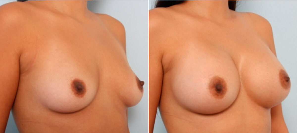 Breast Augmentation before and after photos in Houston, TX, Patient 24952