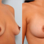 Breast Augmentation before and after photos in Houston, TX, Patient 24952