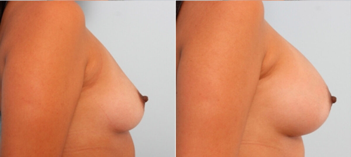 Breast Augmentation before and after photos in Houston, TX, Patient 24952