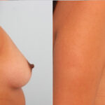 Breast Augmentation before and after photos in Houston, TX, Patient 24952
