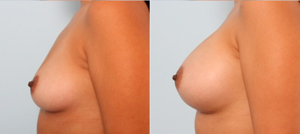 Breast Augmentation before and after photos in Houston, TX, Patient 24952