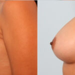 Breast Augmentation before and after photos in Houston, TX, Patient 24952