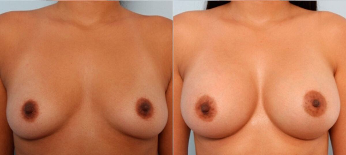 Breast Augmentation before and after photos in Houston, TX, Patient 24952