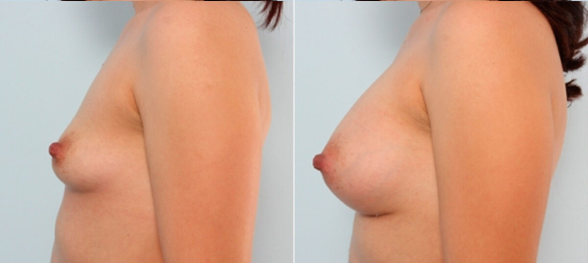 Breast Augmentation before and after photos in Houston, TX, Patient 24963