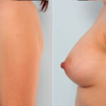Breast Augmentation before and after photos in Houston, TX, Patient 24963