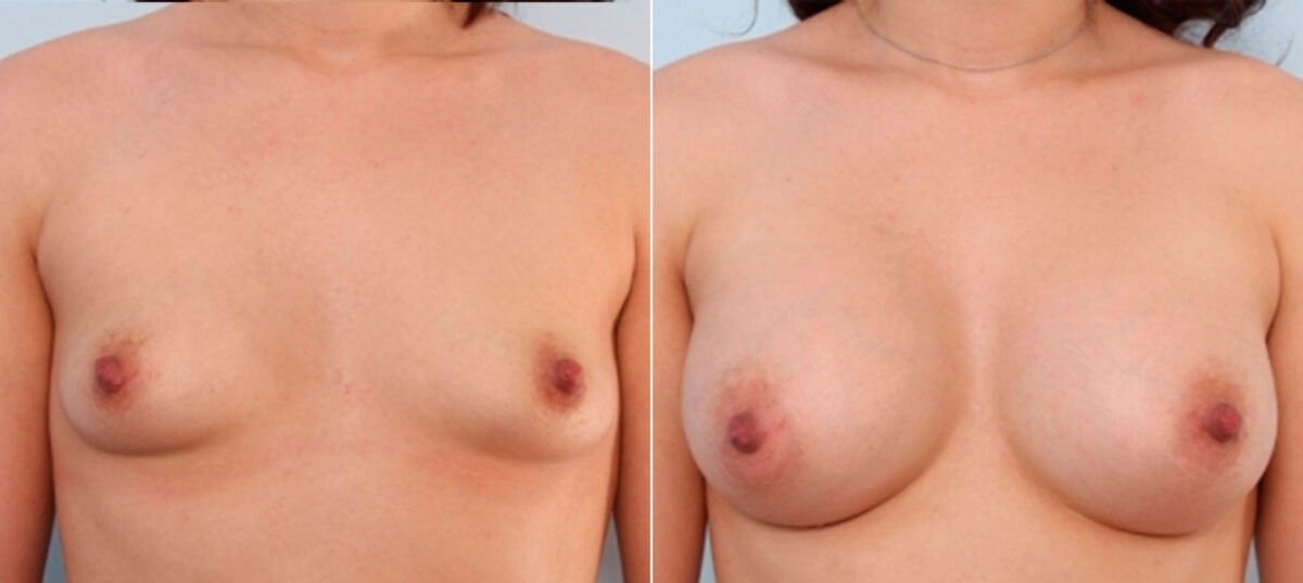 Breast Augmentation before and after photos in Houston, TX, Patient 24963