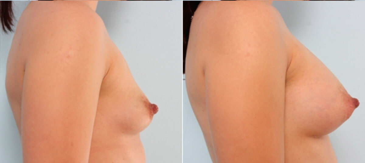 Breast Augmentation before and after photos in Houston, TX, Patient 24963