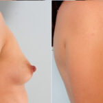 Breast Augmentation before and after photos in Houston, TX, Patient 24963