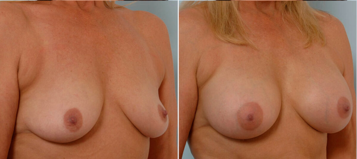 Breast Augmentation before and after photos in Houston, TX, Patient 24974