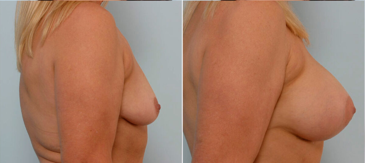 Breast Augmentation before and after photos in Houston, TX, Patient 24974