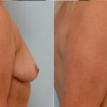 Breast Augmentation before and after photos in Houston, TX, Patient 24974