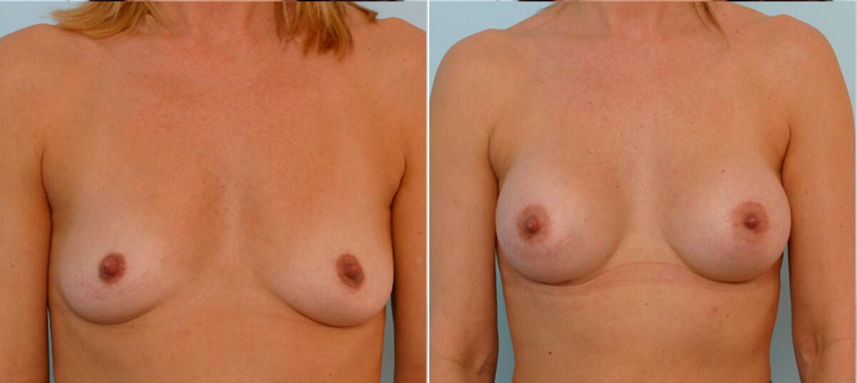 Breast Augmentation before and after photos in Houston, TX, Patient 24981